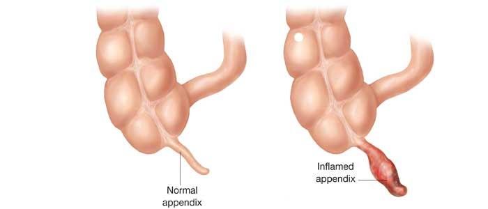apandisit nedir