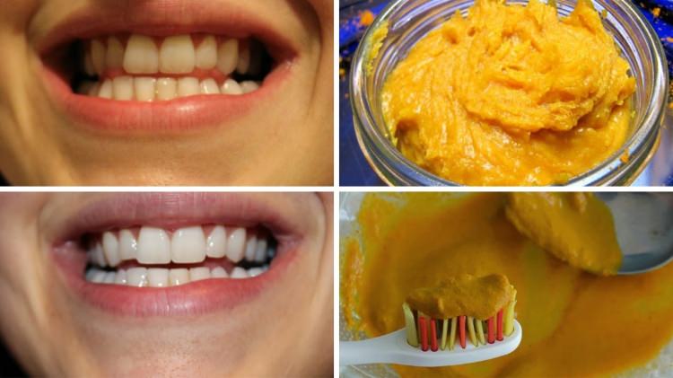 portakal kabuğu diş beyazlatma