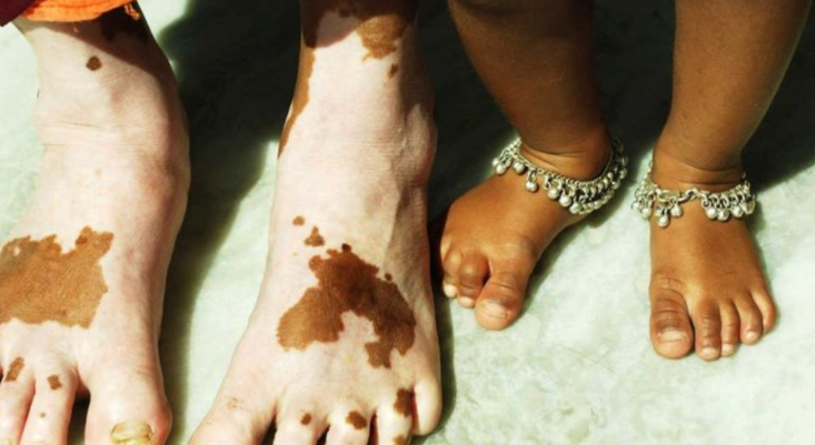 vitiligo hastalığı